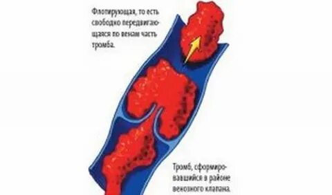 Тест на тромбы