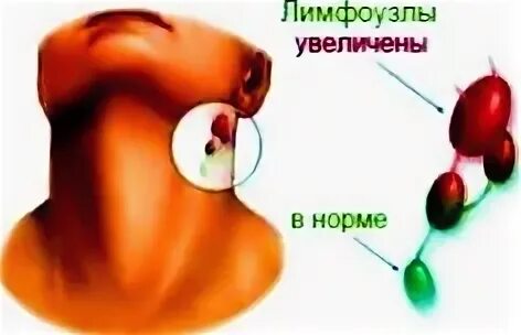 Нормальные лимфоузлы