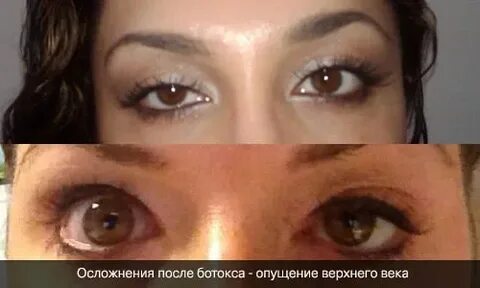 Нависли веки после ботокса что делать