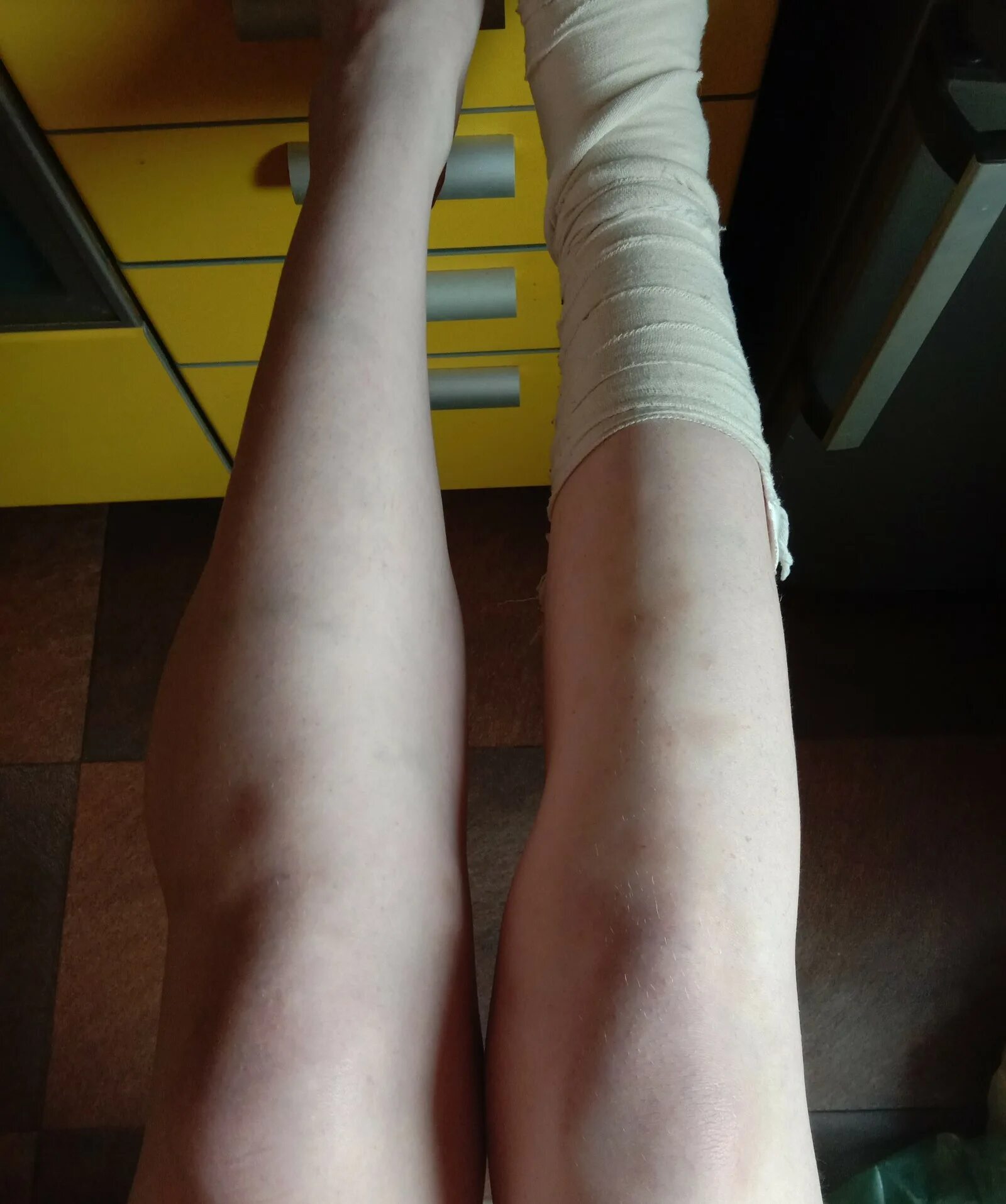 После снятия лангетки. Лангетка на ноге у девушки фото. Нога с лангеткой 2010 год.