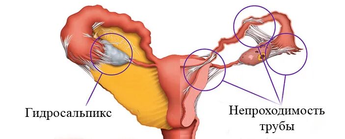 Лапароскопия проходимость труб. Перекрут гидросальпинкса. Лапароскопия маточных труб спайки.