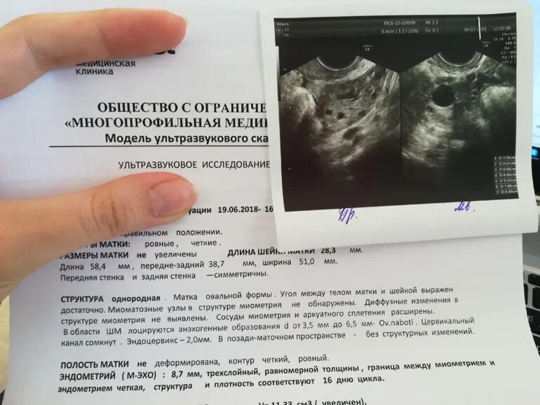 Почему болит яичник при овуляции. Жёлтое тело в яичнике на узи. желтое тело диаметром 22 мм в правом яичнике. жёлтое тело на узи после овуляции. жёлтое тело на узи в яичнике 10мм.