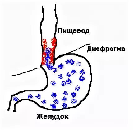 Рефлюкс диафрагмы. Опухоль между пищеводом и желудком. Гастроэзофагеальный рефлюкс рисунок.