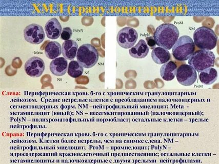 Острый моноцитарный лейкоз