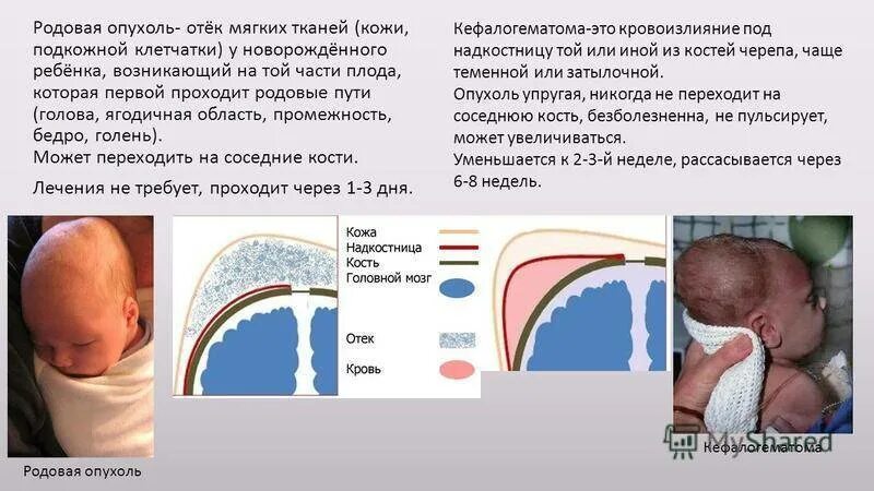 Отек мозга у новорожденных. Кефалогематома и родовая опухоль. Кефалогематома у новорожденного. Родовая травма кефалогематома.