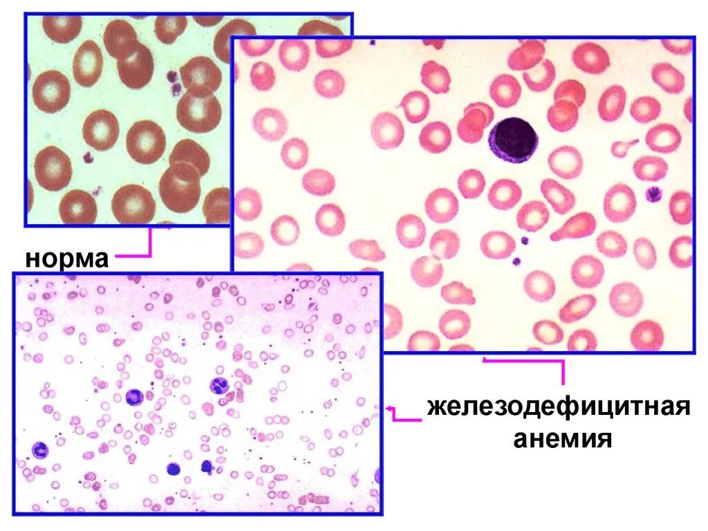 Картина мазка крови при железодефицитной анемии. Микроскопия эритроцитов при железодефицитной анемии. Пойкилоцитоз анемия. Железодефицитная анемия анизоцитоз пойкилоцитоз.