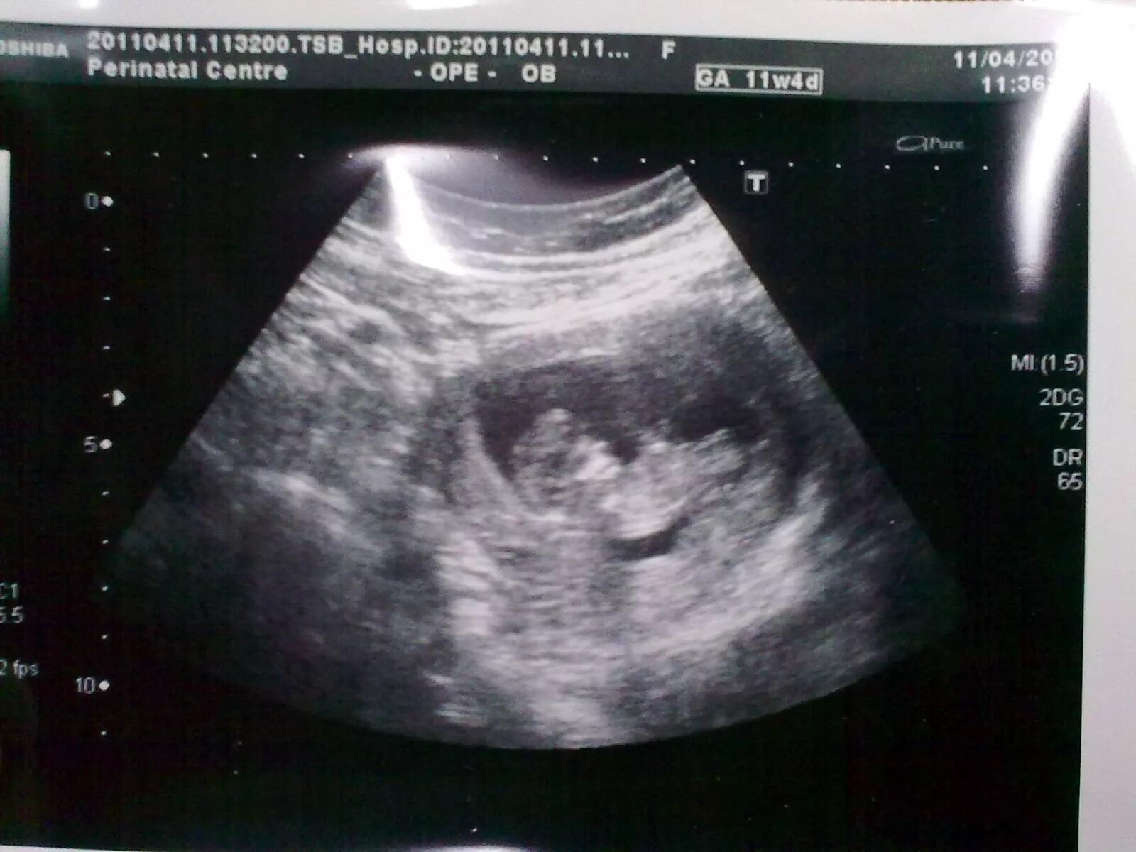 Живот на 11 неделе 4 дня. Узи 11 недель беременности. Узи 11 недель беременности двойня. 11 недель беременности размер. Узи 11-12 недель беременности.