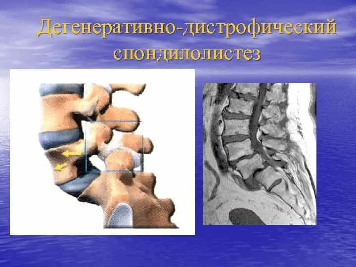 Дистрофические изменения позвоночника. Дегенеративно-дистрофические изменения l2 l3. Дегенеративные изменения грудного отдела позвоночника. Дистрофические изменения в телах позвонков. Спондилолистез.