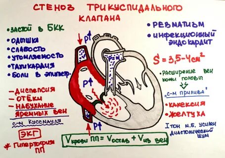 Трикуспидальный стеноз