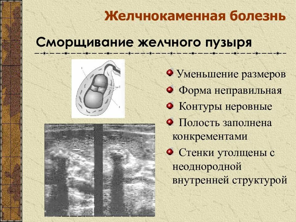 Уменьшенный желчный пузырь. Неоднородное содержимое желчного пузыря. Уменьшение размеров желчного пузыря. Сморщивание желчного пузыря. Неровные контуры стенки желчного пузыря.