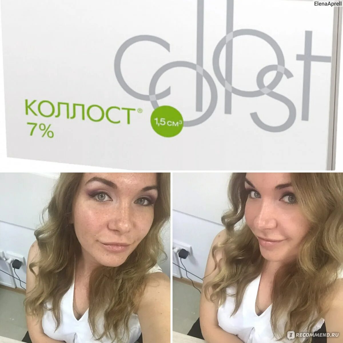 Фотографии до и после лечения рубцов постакне на аппарате М22, проводим в клиник