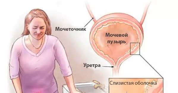 частое мочеиспускание у женщин причины. хождение женщин в туалет бесплатно. цистит у женщин. позывы к мочеиспусканию. цистит у женщин симптомы.
