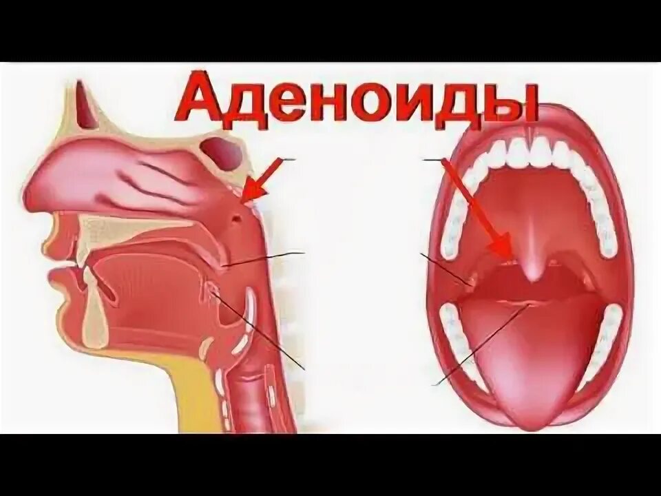 Как вылечить аденоиды у ребенка без операции. Анатомия носоглотки аденоиды. гипертрофия небных миндалин и аденоиды.