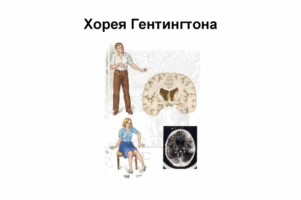 Хорея хантингтона. Болезнь гентингтона симптомы. синдром хорея хантингтона. заболевание хорея гентингтона. синдром хорея гентингтона симптомы.