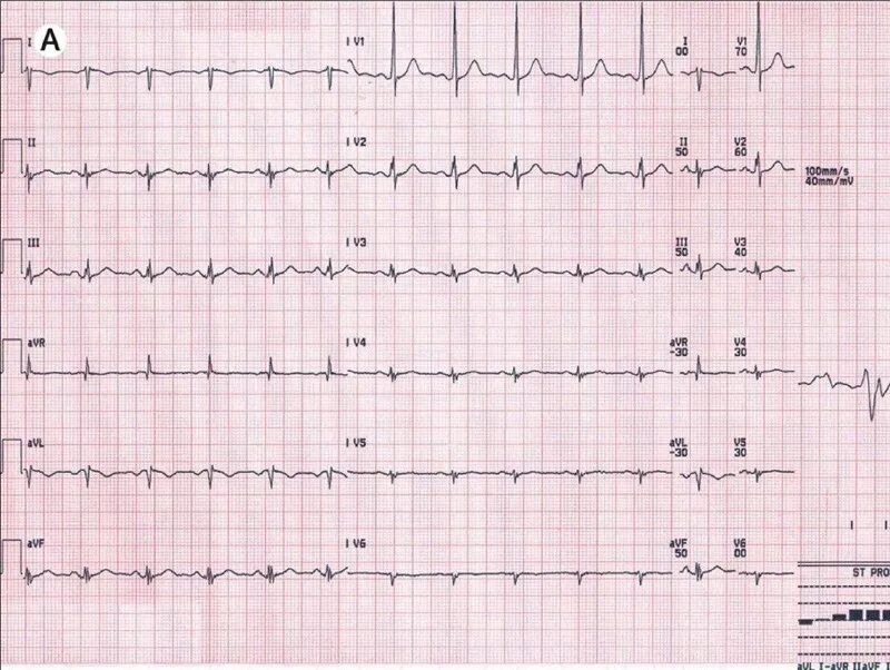 тахикардия вертикальная эос. острая левожелудочковая недостаточность на экг. внутреннее отклонение на экг. передозировка трициклических антидепрессантов на экг. эос.