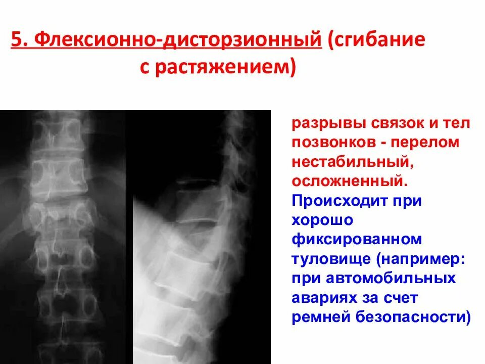 Дистракционные переломы позвоночника. Неосложненный компрессионный перелом. Ротационный перелом позвоночника. Флексионно ротационный перелом.