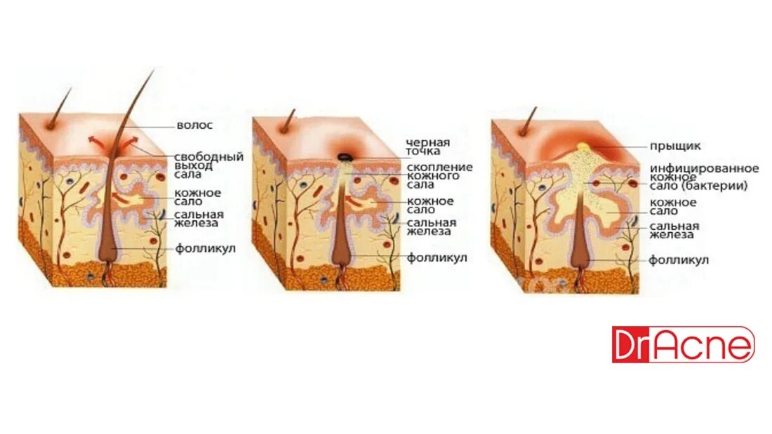 Печень сальные железы. Закупорка волосяного фолликула. Схема образования прыщей.