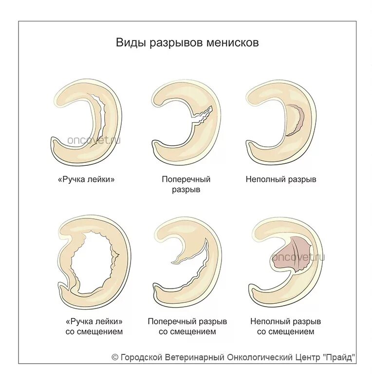 Типы разрывов мениска. Повреждение мениска по типу ручки лейки. Повреждения (разрыва) медиального мениска. Разрыв мениска ручка лейки мрт. Травма мениска по типу ручки лейки.