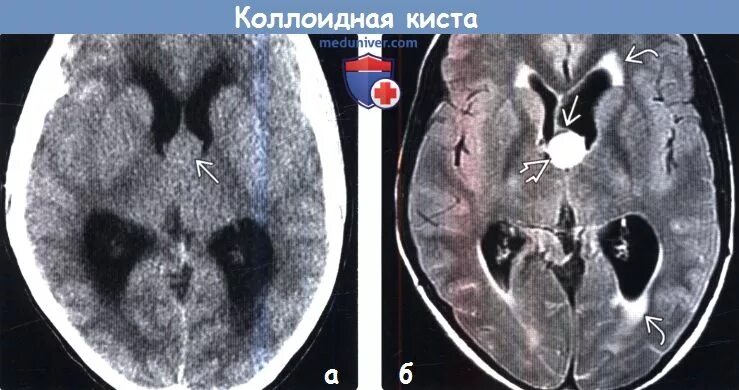 Порэнцефалия левого бокового желудочка. Арахноидальная киста желудочка. Киста левого бокового желудочка. Вентрикуломегалия мрт. Гетеротопия серого вещества кт.