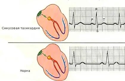 Нерегулярный синусовый