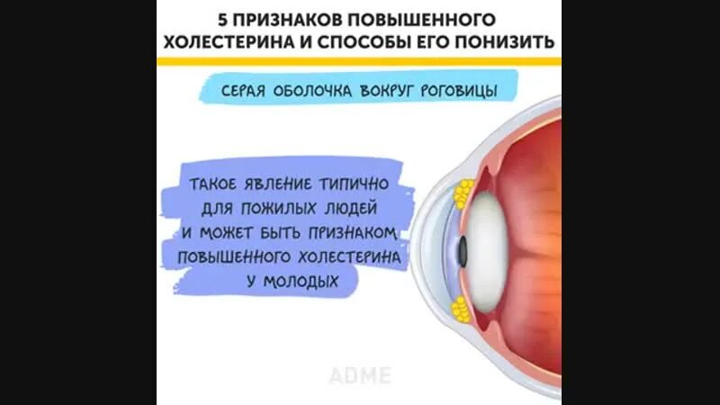 Симптомы повышенного холестерина. Признаки высокого холестерина. Признаки вычокого холестерин. Проявление повышенного холестерина. Повышение холестерина симптомы.