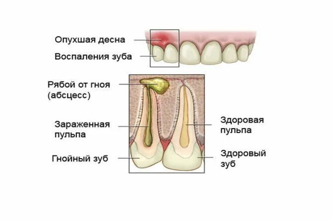 Периодонтальный абсцесс зуба. Где находится десна