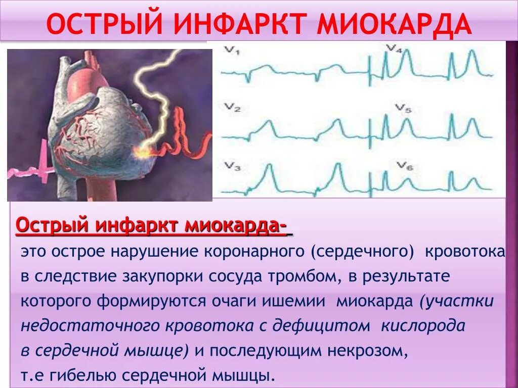 St ишемия. Infrakt Miokart. Острейший инфаркт миокарда.