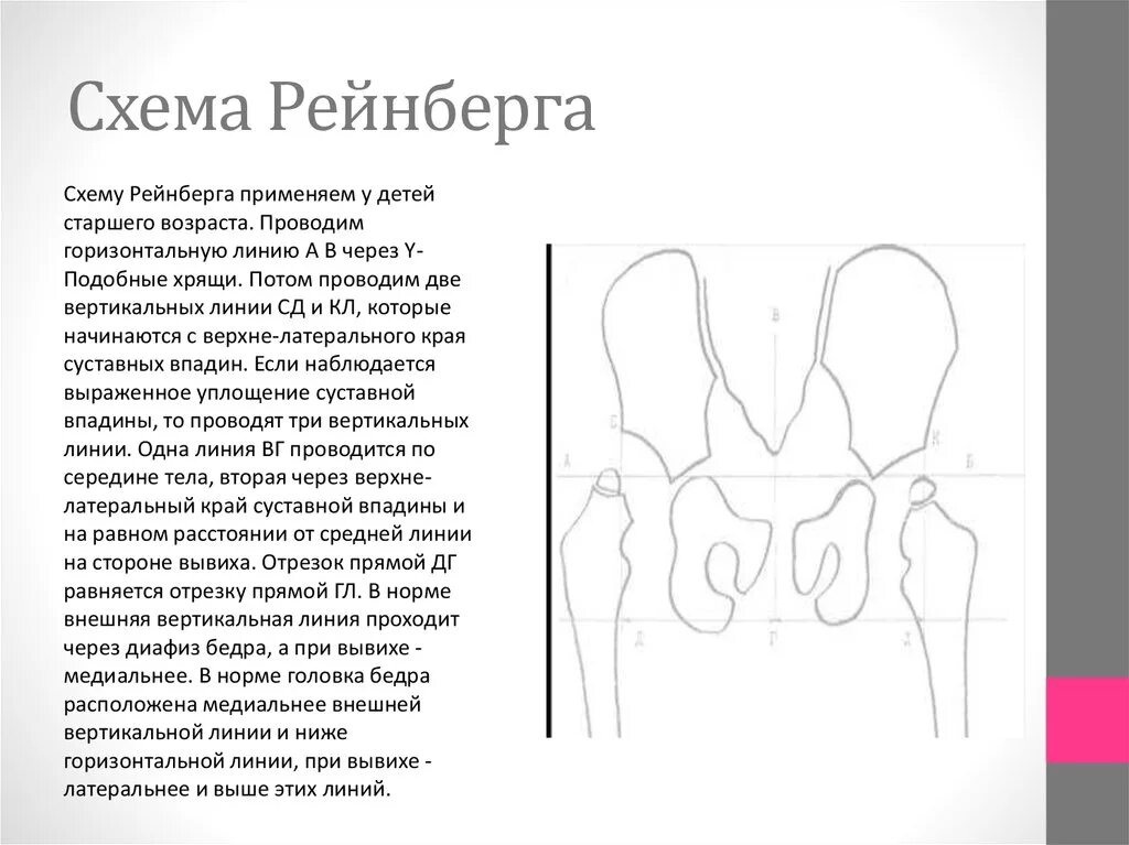 Вывих бедра тест. Схема рейнберга врожденный вывих бедра. схема рейнберга врожденный вывих. дисплазия тазобедренных суставов схема рейнберга. врожденный вывих бедра схема хильгенрейнера.