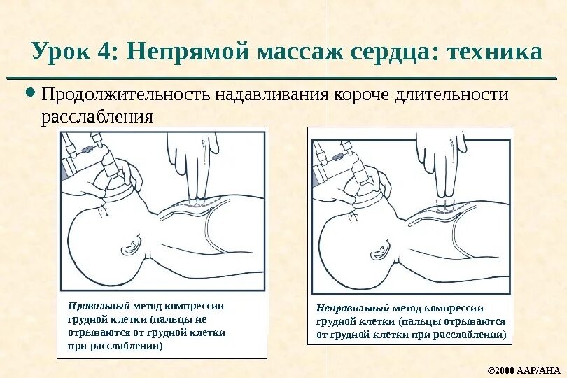 Что такое непрямой массаж сердца. Методика непрямого массажа сердца. техника проведения непрямого массажа сердца. методика выполнения непрямого массажа сердца. непрямой массаж сердца техника выполнения.