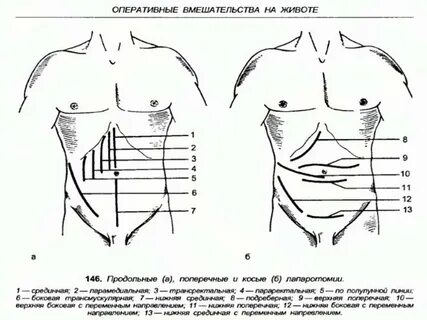 Брюшная стенка после операции