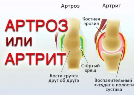 Лечение остеоартроза суставов