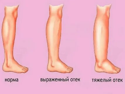 Отек при беременности 36