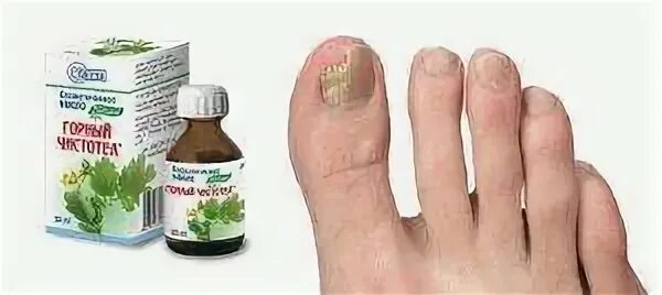 Народные средства от грибка ногтей на ногах чистотелом.