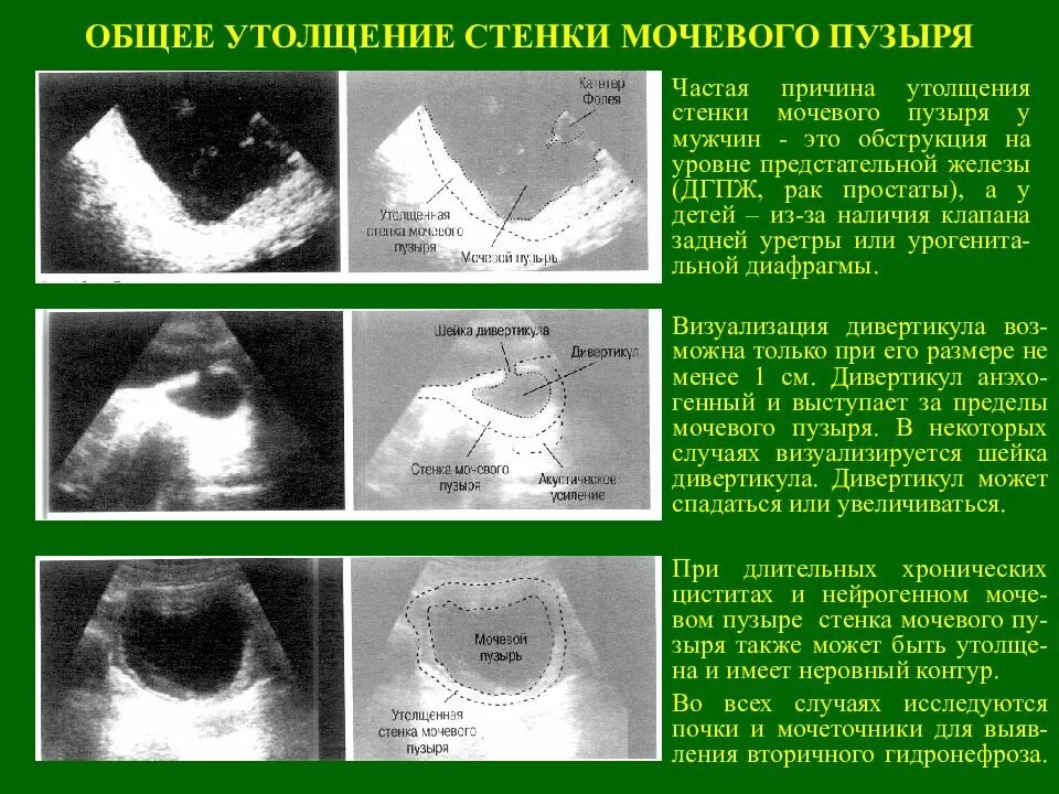 Утолщение мочевого пузыря у мужчин. Толщина стенки мочевого пузыря в норме на УЗИ. УЗИ мочевого пузыря показатели в норме. Стенки мочевого пузыря утолщены УЗИ. Стенка мочевого пузыря норма по УЗИ.