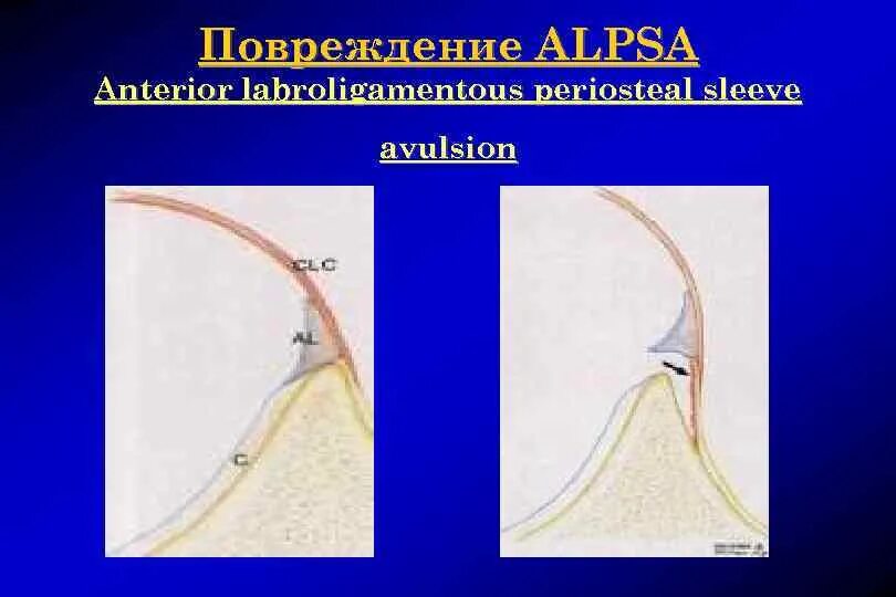 Alpsa повреждение плечевого. Alpsa повреждение плечевого сустава на мрт.