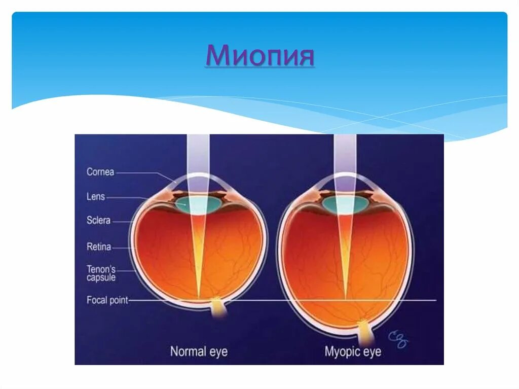 Миопия. Мтопи. Заболевание миопия. Миопия что это простыми словами