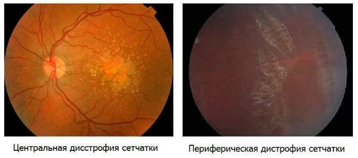 Периферические ретинальные дегенерации. Мелкокистозная дистрофия сетчатки. Дистрофия сетчатки глазное дно. Периферическая отслойка сетчатки. Центральная дистрофия сетчатки глаза.