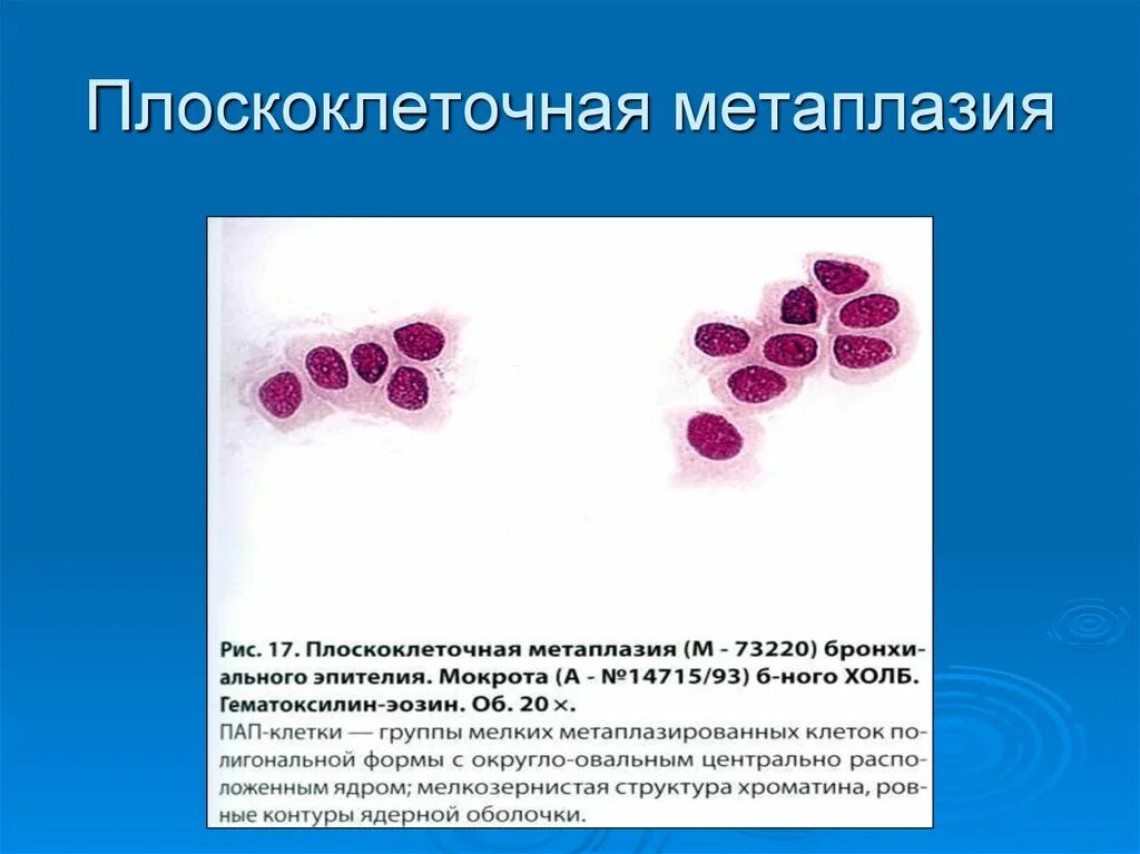 Клетки метаплазированного эпителия с реактивными изменениями. Плоскоэпителиальная метаплазия. Метаплазия эпителия шейки матки цитология. Плоскоклеточная метаплазия цитология. Плоскоклеточная метаплазия шейки матки цитология.