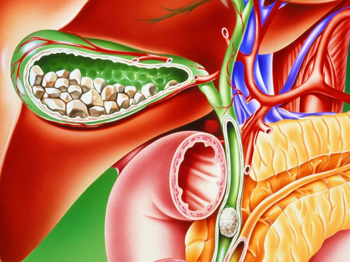 Проблемы с печенью желчным пузырем. Холецистит желчного пузыря. Желчнокаменная болезнь холецистит. ЖКБ камни желчного пузыря. Холецистит камни в желчном пузыре.