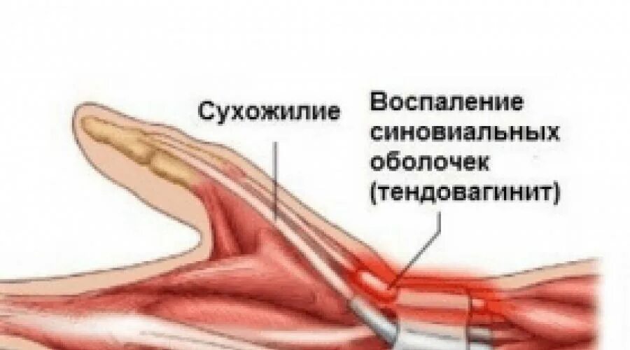Тендинит сухожилия сгибателя пальца. Тендинит сухожилия сгибателя пальца