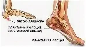 Как проявляется пяточная. Как проявляется пяточная