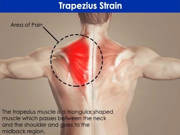 Болезненность трапециевидной мышцы. Миозит трапециевидной мышцы. Боль в трапециевидной мышце справа. Воспаление верхней части трапециевидной мышцы. Back area