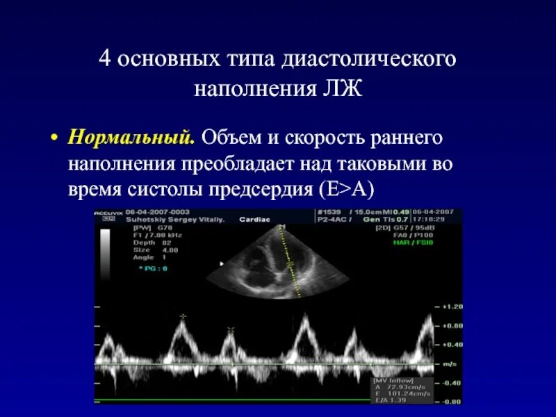 Ддлж по 1 типу по узи сердца