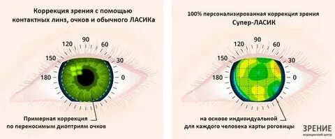 После лазерной коррекции зрение вблизи хуже