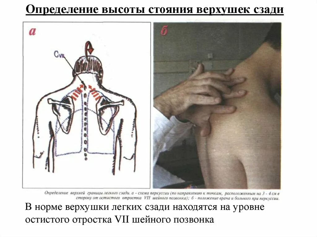 Топографическая перкуссия верхушки легких. Верхние границы легких перкуссия. Верхушки легких в норме