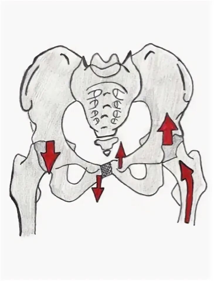 Изменения костей таза. Pelvis imbalance. Крестец и таз. Тазовый крестец.