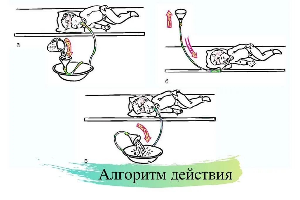 Количество жидкости необходимой для промывания желудка. Промывание желудка алгоритм. Количество жидкости необходимой для промывания желудка. Промывание желудка у детей алгоритм. Количество жидкости необходимой для промывания желудка.