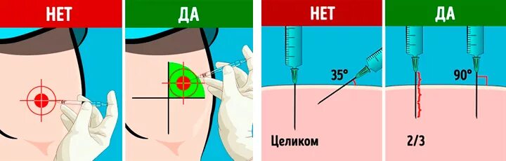 Болезненный ли укол. Правильно поставить укол внутримышечно. Как правильно делать укол в ягодицу. Укол внутримышечно схема. Куда ставить укол в ягодицу внутримышечно правильно.