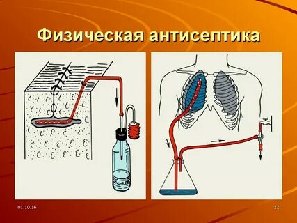 Дренирование ран