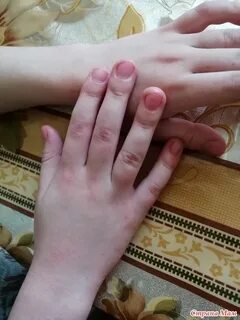 Холод чешется
